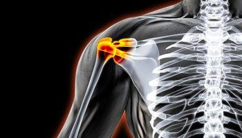 Prescott-Valley-Orthopedic-Surgeon-total-shoulders-replacement #DavisOrthopaedics