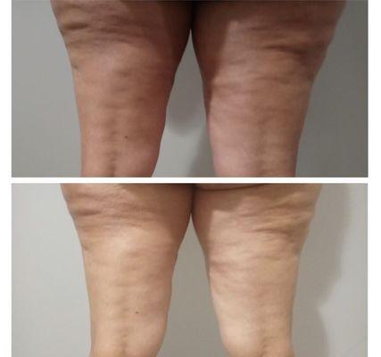 cellulite treatment *