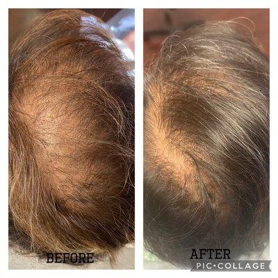 Before and After of PRP hair treatment