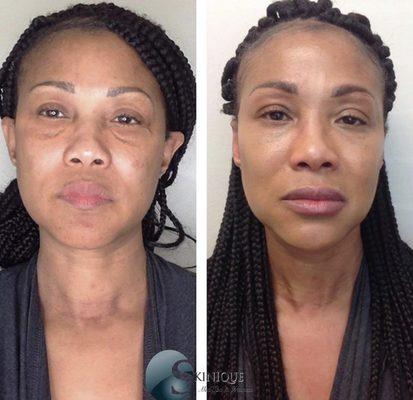 Before and after using Voluma in cheeks, Volbella under the eyes, and Vollure in lips