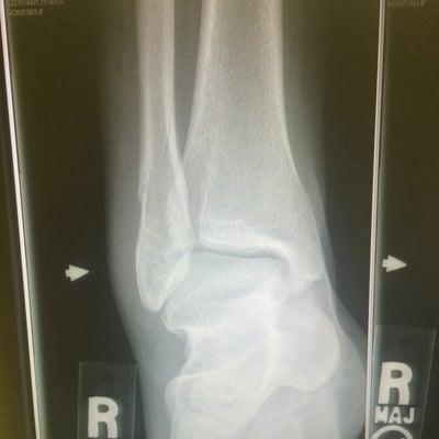 Broken fibula!!