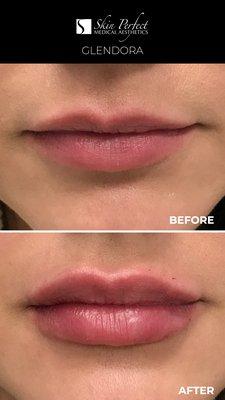 Soft, natural-looking lips are achieved with Injectable Fillers. This is before and immediately after lip injections by Jeremy Romaine, PA-C