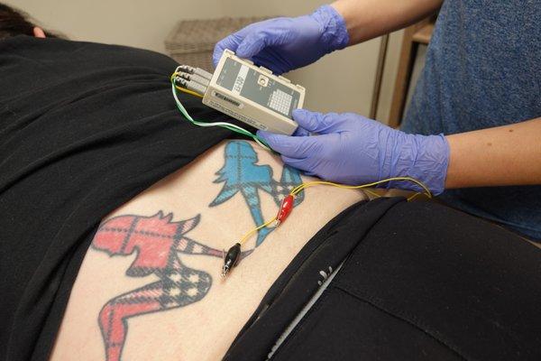 Dry needling with electrical stimulation for low back pain