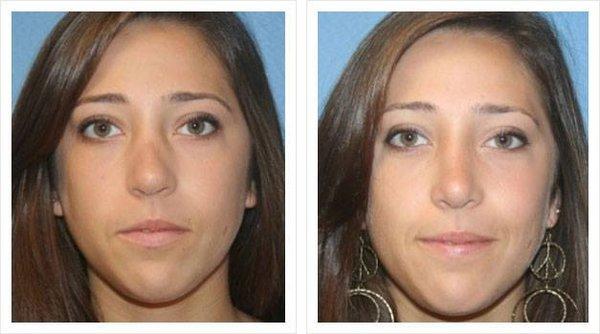 Rhinoplasty