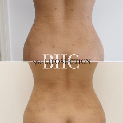 360 liposuction