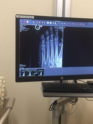 My broken foot. I had to get this photo from my podiatrist. I asked Dr Yee to send it to me and he never did.