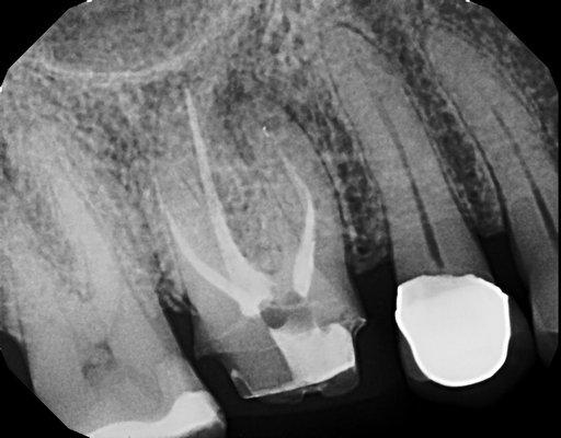 UCSF Endodontic school  defective root canal , with infection and broken tool end left imbedded .