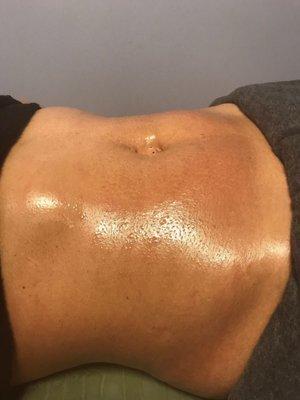 Stretch Marks Removal 1