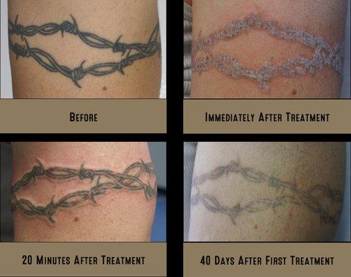 Our cutting-edge Quanta Q-Plus C laser can deliver amazing results with just a single treatment - helping to facilitate a tattoo cover-up!