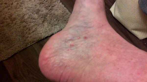 Fungus on the foot.