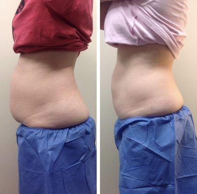 CoolSculpting before and after