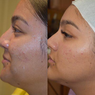 Microneedling with PRP