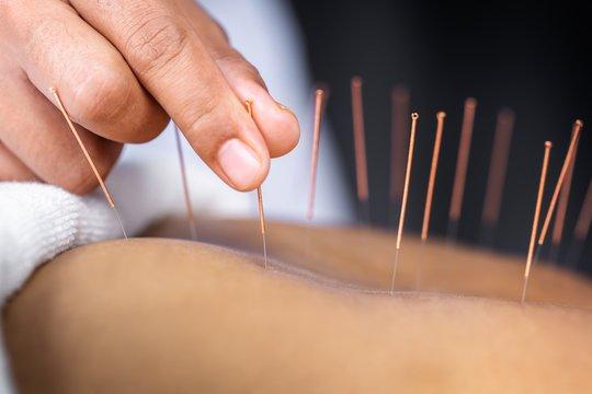 Acupuncture