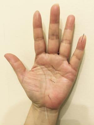 Koryo hand acupuncture performed by Dr.Chung