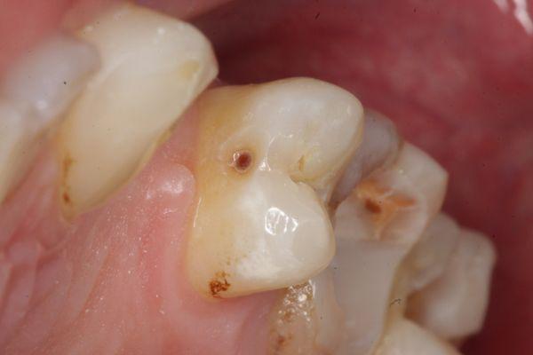 This is a macro photo of my tooth thanks to the doctor that I have equipment through which you can see a microcrack