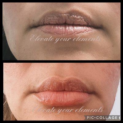 Your lips, only better! Filler can look natural and give your face a more balanced youthful look