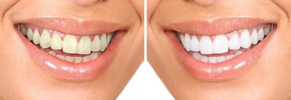 Vancouver Teeth Whitening