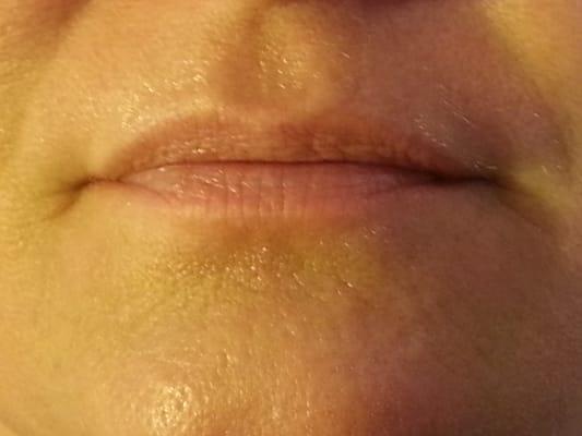 Before Permanent Full Lips