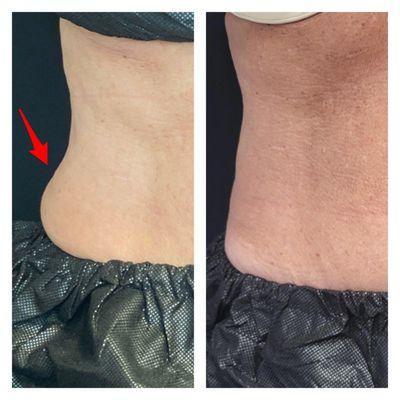 Coolsculpting Fat Freeze before and after