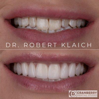 Dr. Rob rejuvenated this patient's smile with 16 porcelain veneers (8 on the upper arch, and 8 on the lower arch).