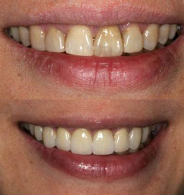 Before and After Photo by Tacoma Cosmetic Dentist at Advanced Dental Care