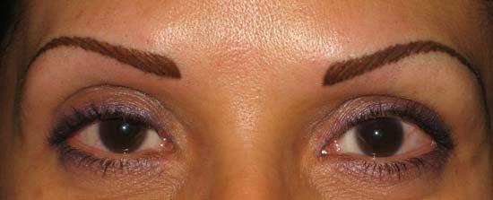 Newly completed permanent eyebrows.