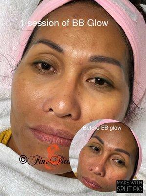 Before and after of 1 BB glow treatment session