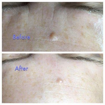 Before and after one hour facial and Microcurrent