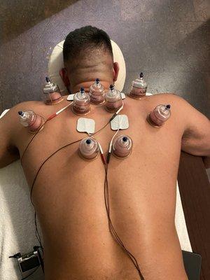 Cupping with Muscle Stim to get a nice shearing effect.