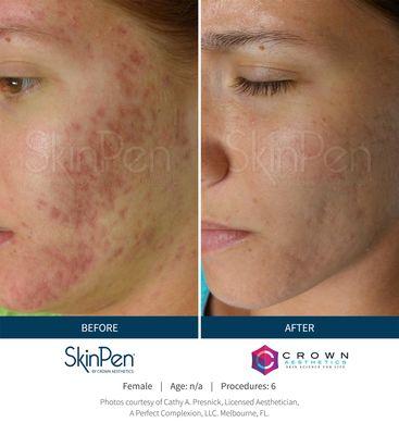 Acne Marks before and after microneedling