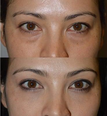 Young female with under eye bags who underwent transconjunctival lower blepharoplasty with fat repositioning and skin pinch.