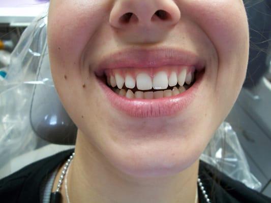 Ask us about "instant orthodontics." Direct resin bonding works beautifully. See the next photo of this college student!