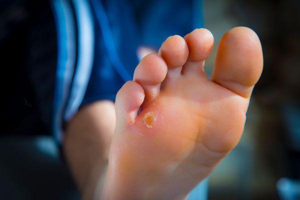 We know kids!  
We know warts and how to treat them well.  Avoid spread and avoid incorrect treatment.