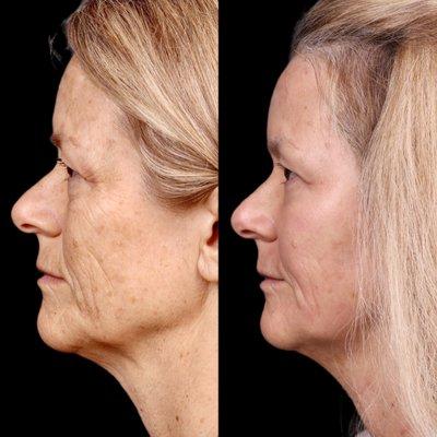 Cheek filler, Full face CO2 laser (10d after treatment)