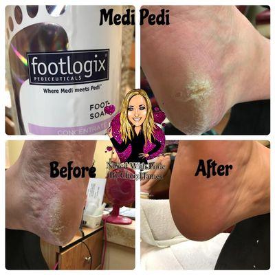 Diabetic Pedi Footlogix