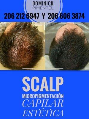 SCALP MICROPIGMENTACIÓN CAPILAR