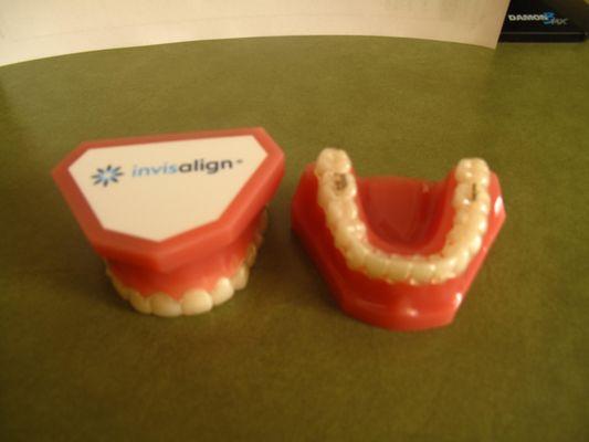 Offer Invisalign