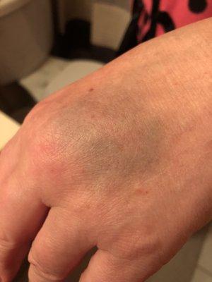 Bruising and swelling after Routine blood work not being able to find a vein.