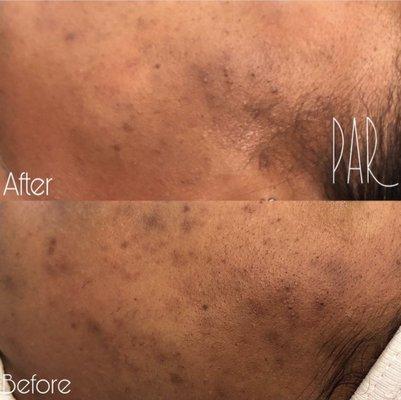 microneedling 1 session