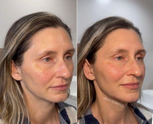 Facial balancing with filler