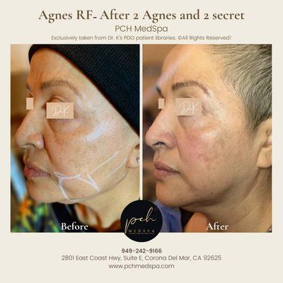 PDO Thread Lift + Agnes RF Treatment