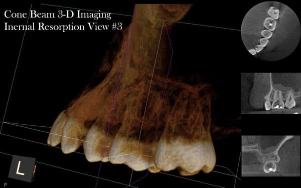 Third view of a Cone Beam 3-D image of Internal Root Resorption