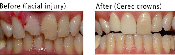 upper 3 teeth were damaged. Two teeth were restored in 3 hours, same day with Ceramic crowns (Cerec). Last tooth with filling