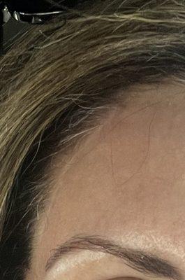 Surgical scar from brow lift