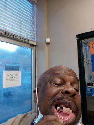 This is incompetence. My father went to Western Dental today for an extraction...this is what they did to him, cut out the bone.