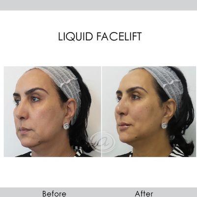 Liquid facelift