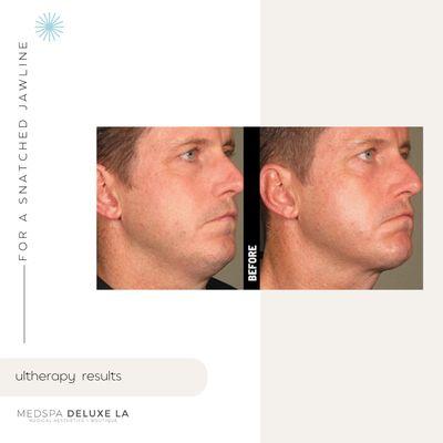 Ultherapy for skin tightening under the chin for a more defined jawline