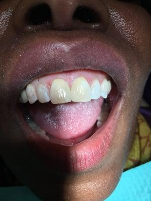 Patient became excited after we close her gap using the latest in chair-side composite veneer techniques...