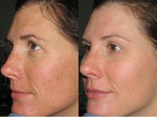 IPL Laser Treatment - Before and After (results after 3 treatments.)