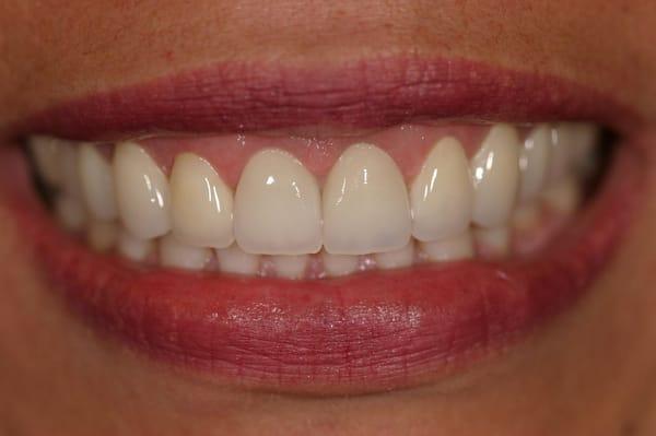 Porcelain Veneers